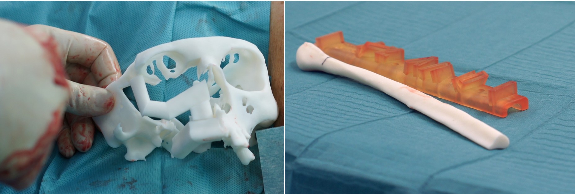 Fig. 2 Anatomial models with the surgical guide for the fibula osteotomies.