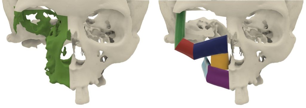 Fig. 1 Visualization of the large defect of the right maxilla and the virtual preplanned position of the fibula graft.